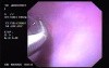 Hemorrhage due status post rubber band ligation of esophageal varices (7 of 25)