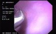 Hemorrhage due status post rubber band ligation of esophageal varices (7 of 25)