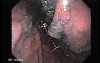 Multiple Irregular and Large Ulcers - Assessment of the Mucosa