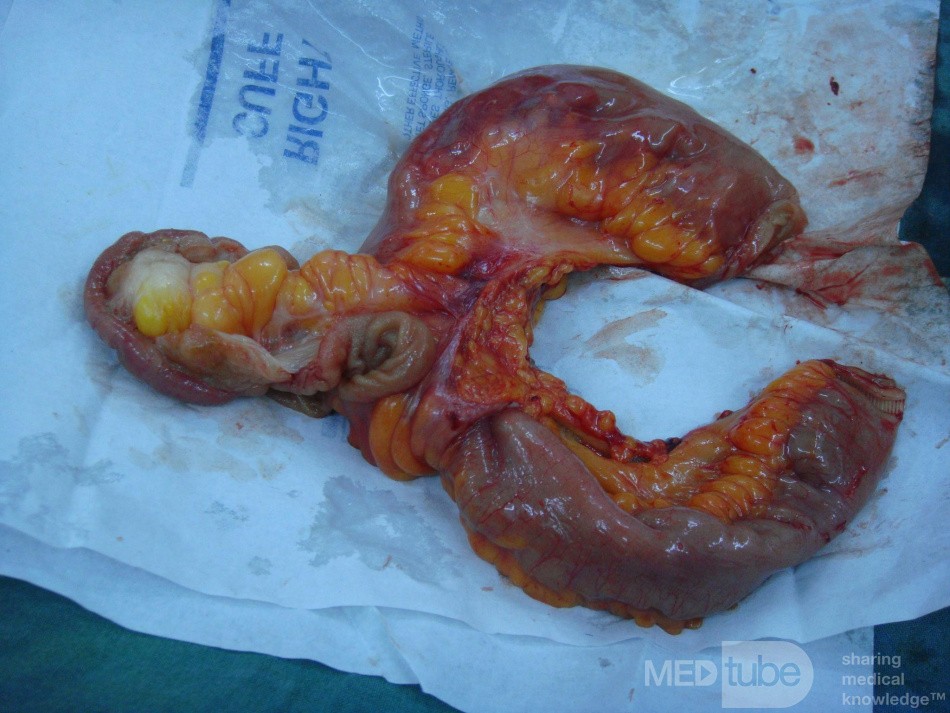 Meckele's diverticulum