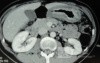 Endoscopy of Scirrhous Gastric Carcinoma involving the entire Fundus, Body and the Antrum (23 of 47)