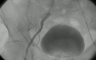 Atherosclerotic Femoral Artery