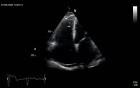 Impaired Right Ventriculi Function