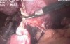 Laparoscopic removal of Liver cyst