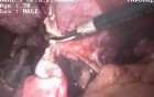 Laparoscopic removal of Liver cyst