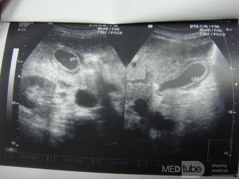 Acute acalculus cholecystitis - on ultrasound