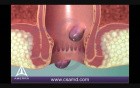 Hemorrhoids - 3D Medical Animation