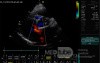 Ostium Secundum Atrial Septal Defect (ASD)