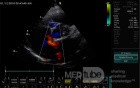Ostium Secundum Atrial Septal Defect (ASD)
