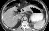 ScirrhousGastric Carcinoma (Linitis Plastica) (9 of 9)