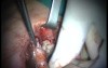 Regeneration Of Multialveolar Process 16-17 (3/4