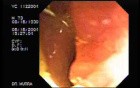 Crohn´s Disease of the Ileocecal Valve and Terminal Ileum (5 of 5)