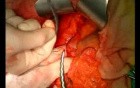 Open Right Hemicolectomy – Technical Principles - Operation No 1B - Part 1