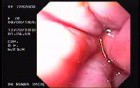 Hemorrhage Due Status Post Rubber Band Ligation of Esophageal Varices - Source of Bleeding, Part 1