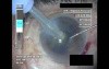 Cataract Surgery IV - Part 3
