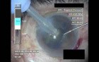 Cataract Surgery IV - Part 3