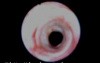 Tracheal Stenosis - Bronchofiberoscopy
