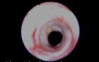 Tracheal Stenosis - Bronchofiberoscopy