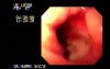 Adenocarcinoma of the Pylorus - Endoscopy