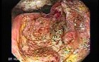 Adenocarcinoma of the Antrum (1 of 5)