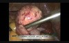 Laparoscopic Ovarian Cystectomy