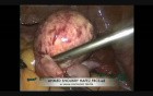 Laparoscopic Ovarian Cystectomy