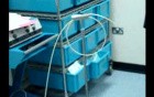 Laser liposuction surgery