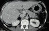 Endoscopy of Scirrhous Gastric Carcinoma involving the entire Fundus, Body and the Antrum (19 of 47)