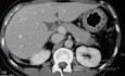Endoscopy of Scirrhous Gastric Carcinoma involving the entire Fundus, Body and the Antrum (19 of 47)