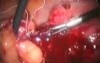Laparoscopic Treatment Of Bowel Injury By IUD (Intrauterine Device)
