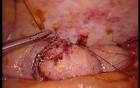 Colonic Perforation With Peritonitis - Laparoscopy (10 of 46)