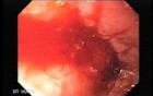 Adenocarcinoma of the middle third (4 of 5 )