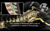 Interlaminar Injection