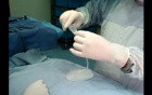 Breast implants - surgical video
