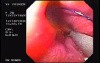 Flexible Endoscopic Suturing - Endoscopic Anti-Reflux Procedure