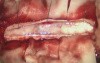 Spine Surgery