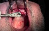 Re-Entry Placement - Implant Surgery, #8 Site