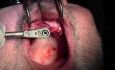 Re-Entry Placement - Implant Surgery, #8 Site