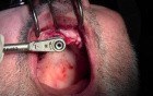 Re-Entry Placement - Implant Surgery, #8 Site