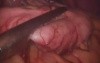 Lap. Sleeve Gastrectomy