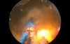 Greenlight HPS - Prostate