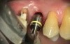 How To Profile Alveolar Process Bone?