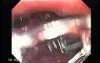 Early Gastric Cancer - Endoscopy (4 of 21)