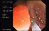 Tubulo - Villous Adenoma - Endoscopy (5 of 28)