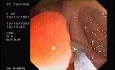 Tubulo - Villous Adenoma - Endoscopy (5 of 28)