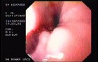 Esophageal Achalasia (16 of 16)