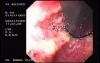 Hemorrhagic Esophagitis Due To Alcoholism - Cardia