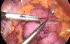 Small bowel anastomosis - laparoscopic surgery