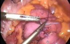Small bowel anastomosis - laparoscopic surgery
