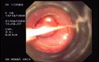 Banding of Esophageal Varices - Assessment of Esophagus, View Through Banding Device